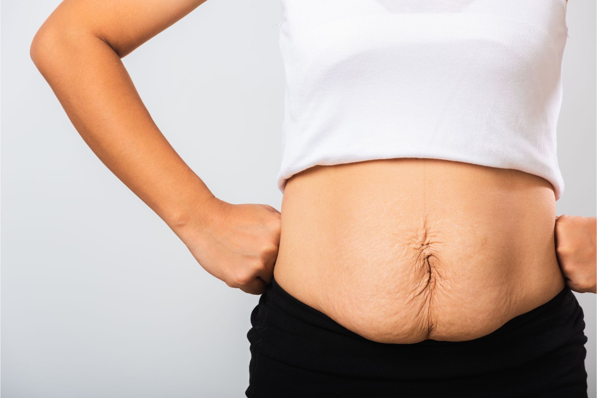 Abdominoplastia, vatsan muotoilu, ylimääräisen ihon poistaminen vatsan alueelta