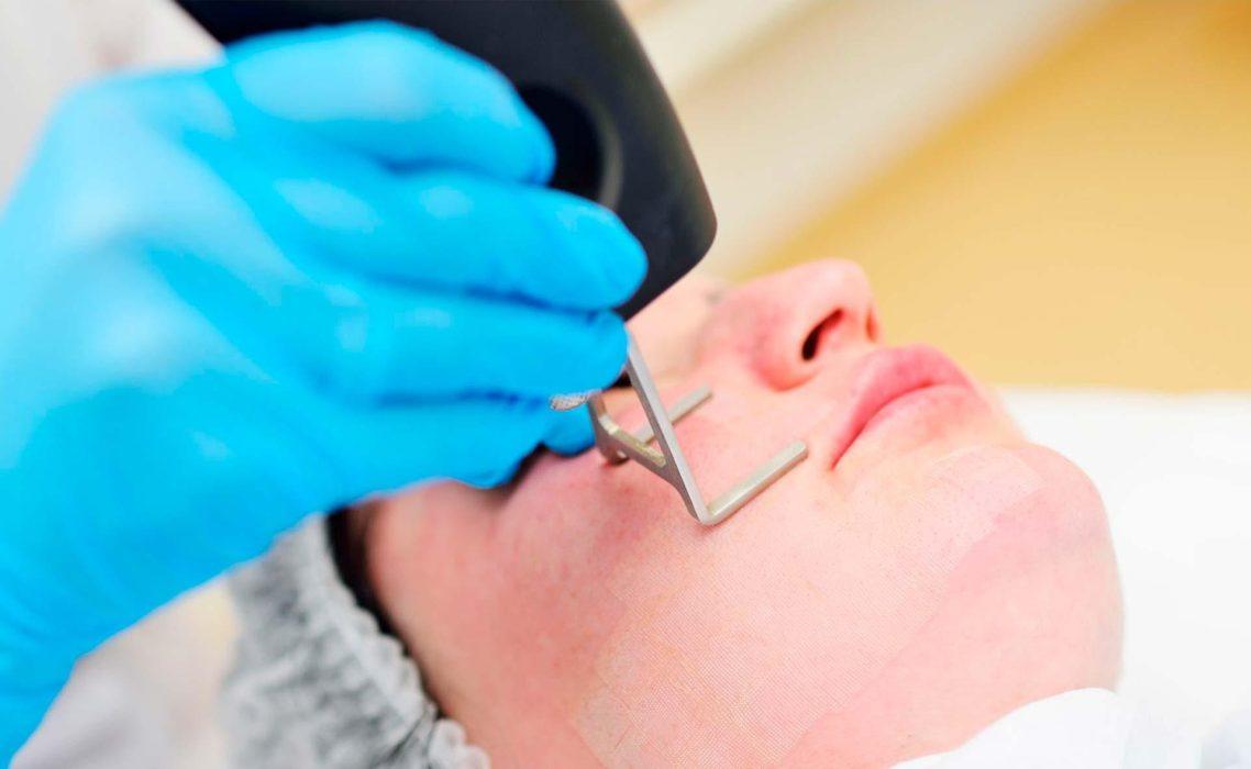 10 kysymystä fraktioiduista laserhoidoista