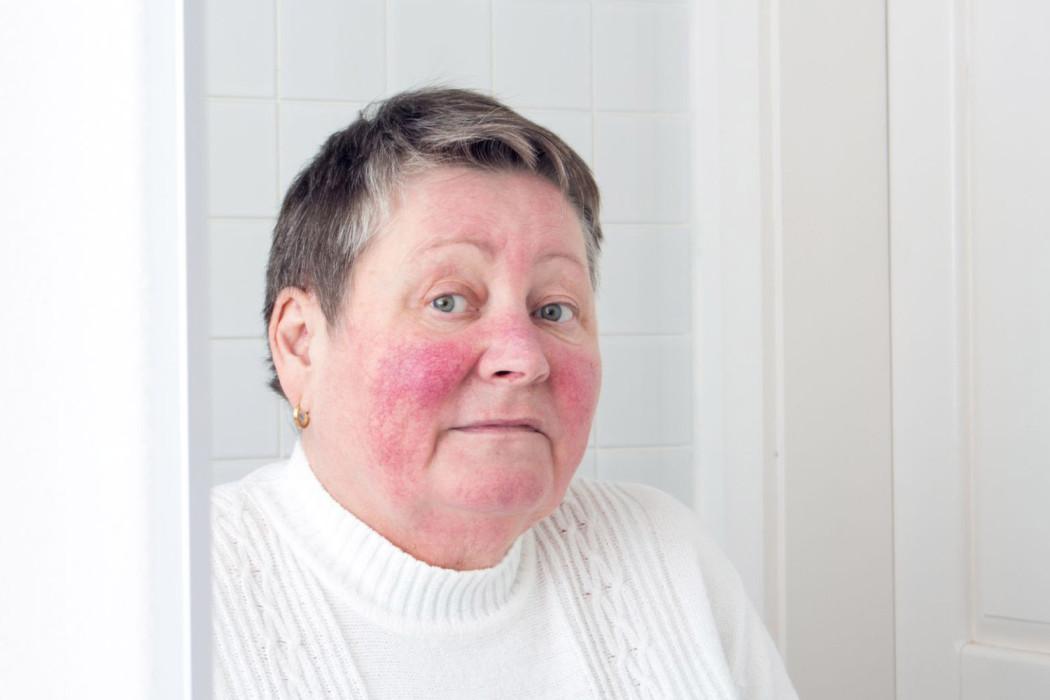 Ruusufinni eli rosacea