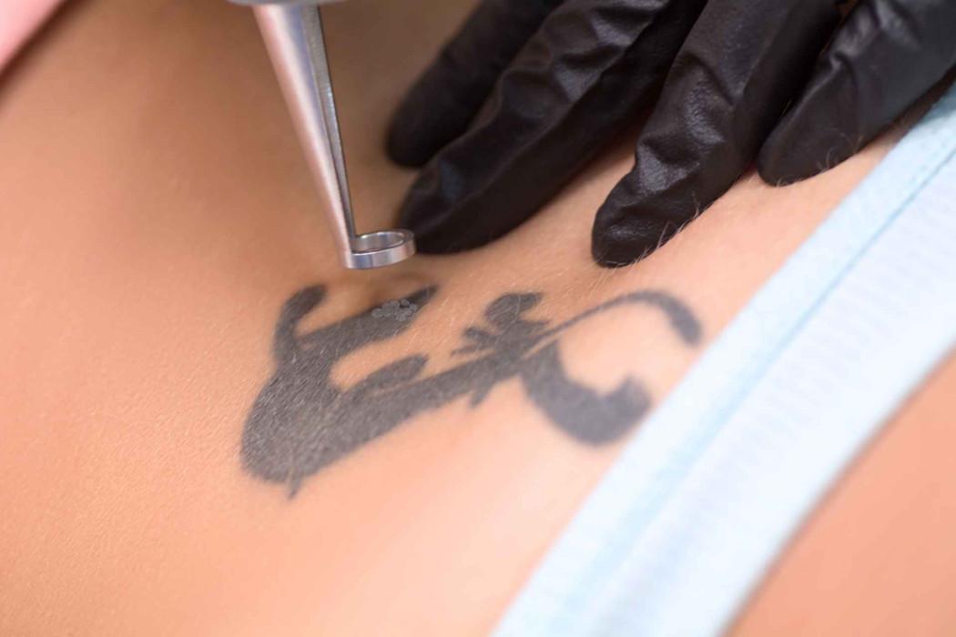 Tatuoinninpoistolaser