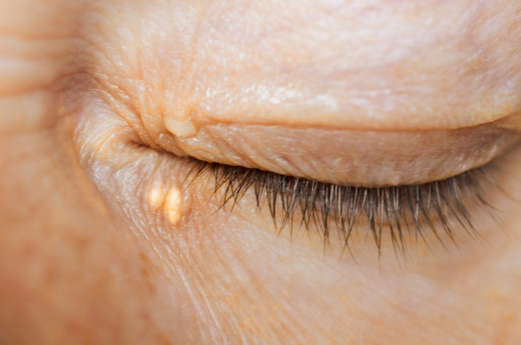 Close up of woman eyes with Xanthelasma on the eyelids. Hypercholesterolemia, high cholesterol